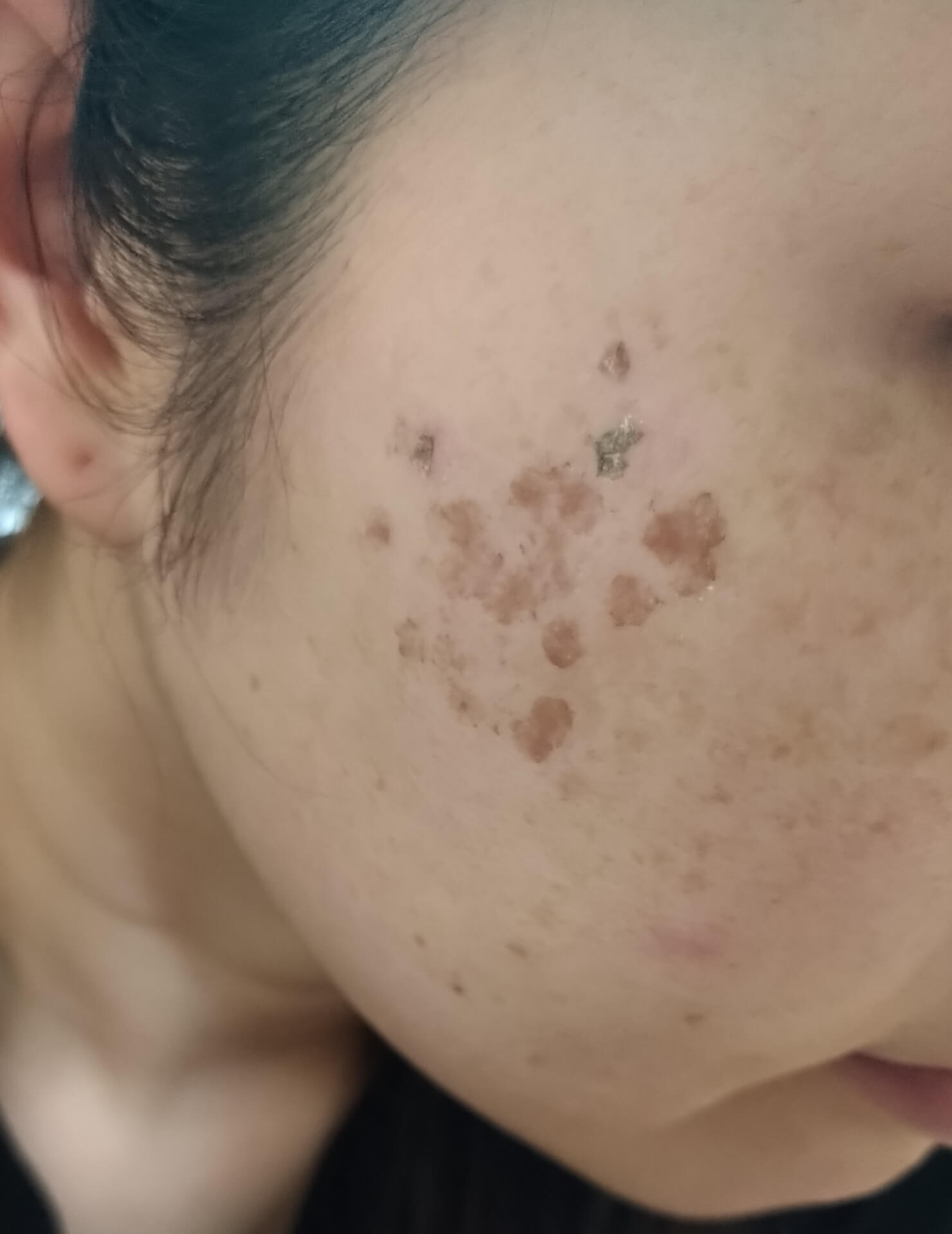 レーザー治療後の経過と注意点について