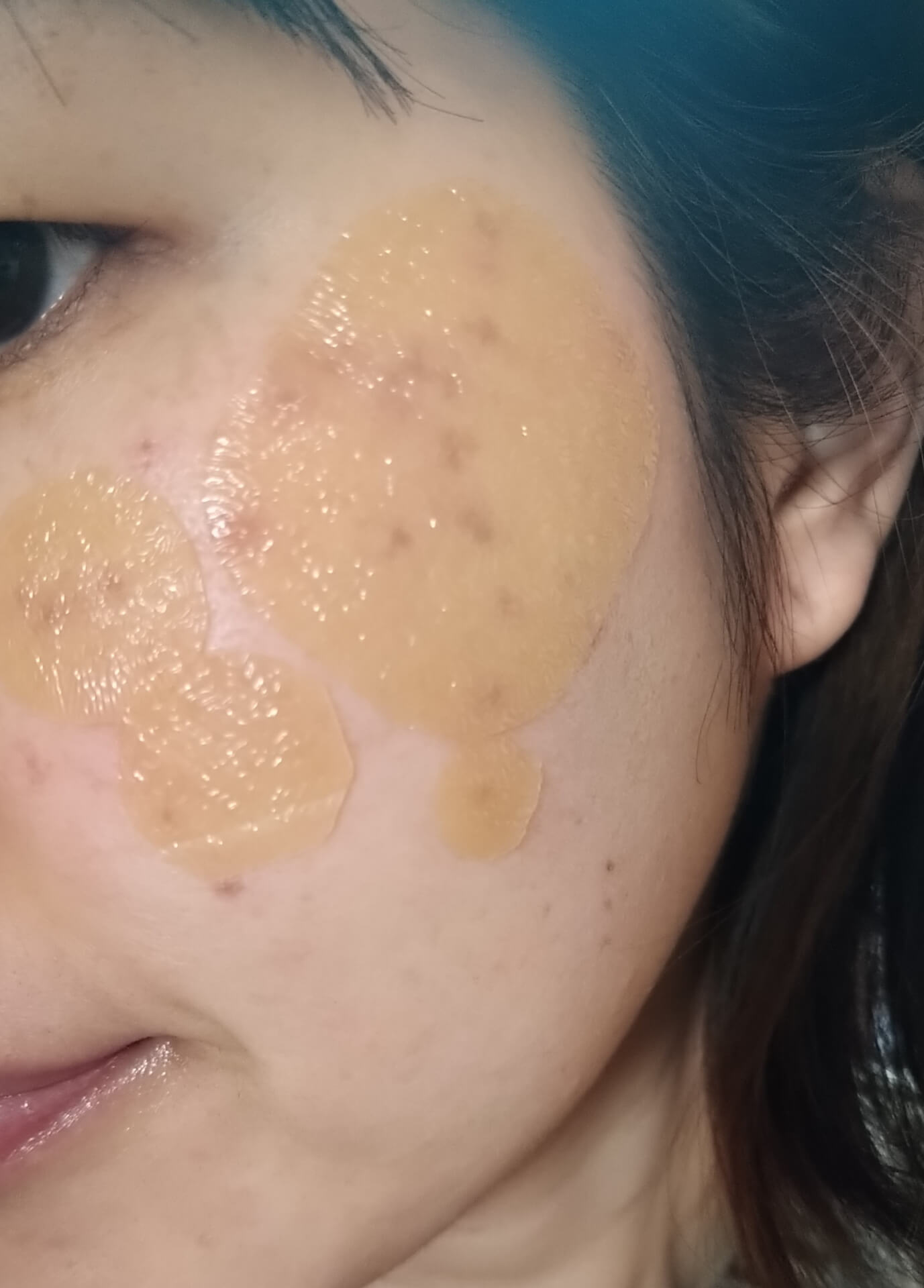 顔全体のシミ取りを考えるときの注意点